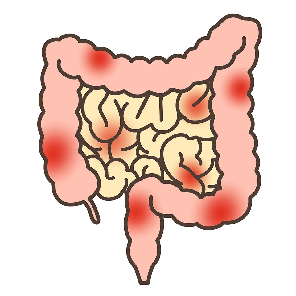 過敏性腸症候群