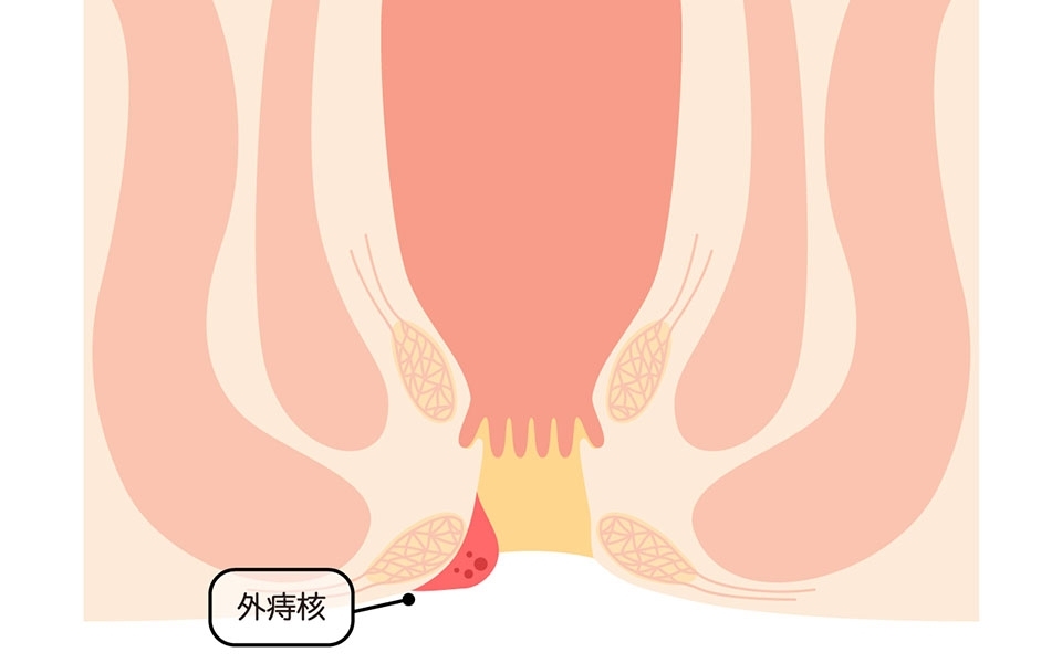 痔核（いぼ痔）